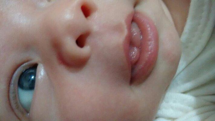 Otorrinolaringologistas alertam para aumento  de cirurgia de língua presa em bebês