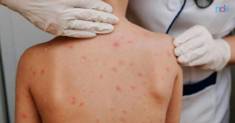 Cidades de SC registra casos de sarna humana em escolas