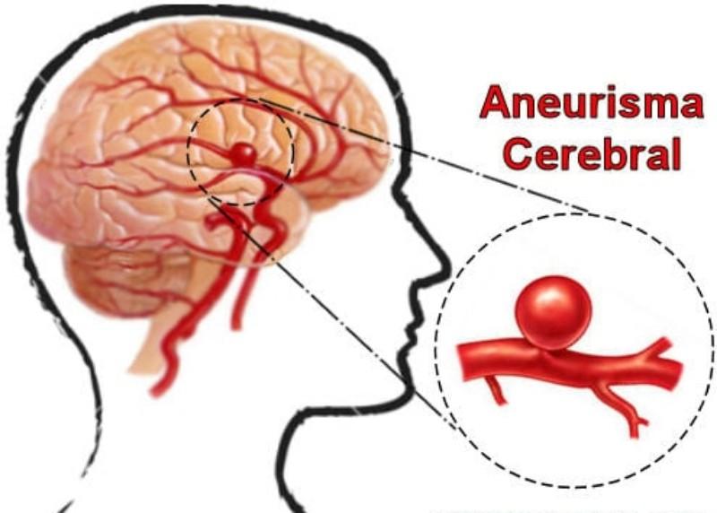 Sintomas de um Aneurisma Cerebral e tratamento