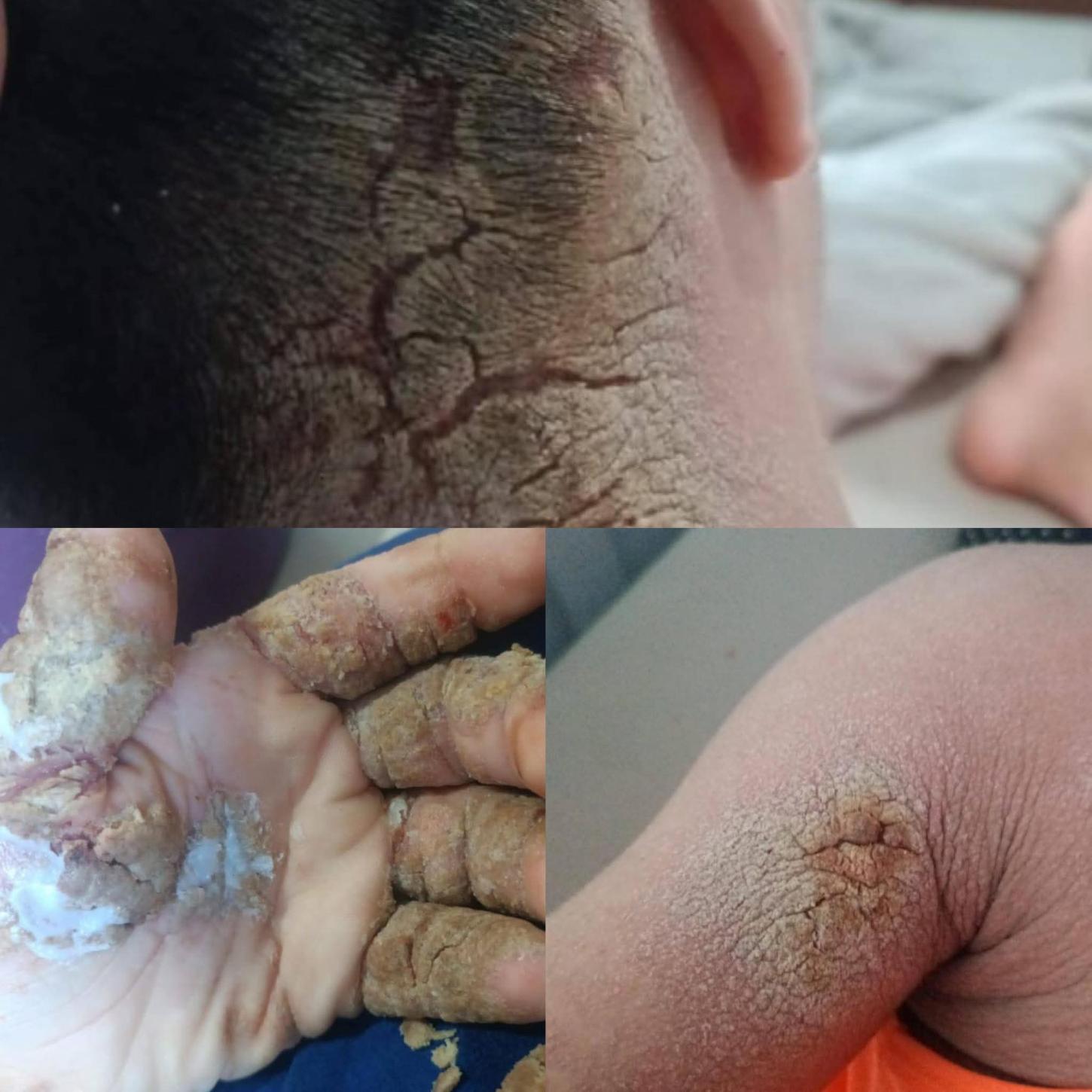 Adolescente luta contra doença de pele misteriosa em Canoinhas