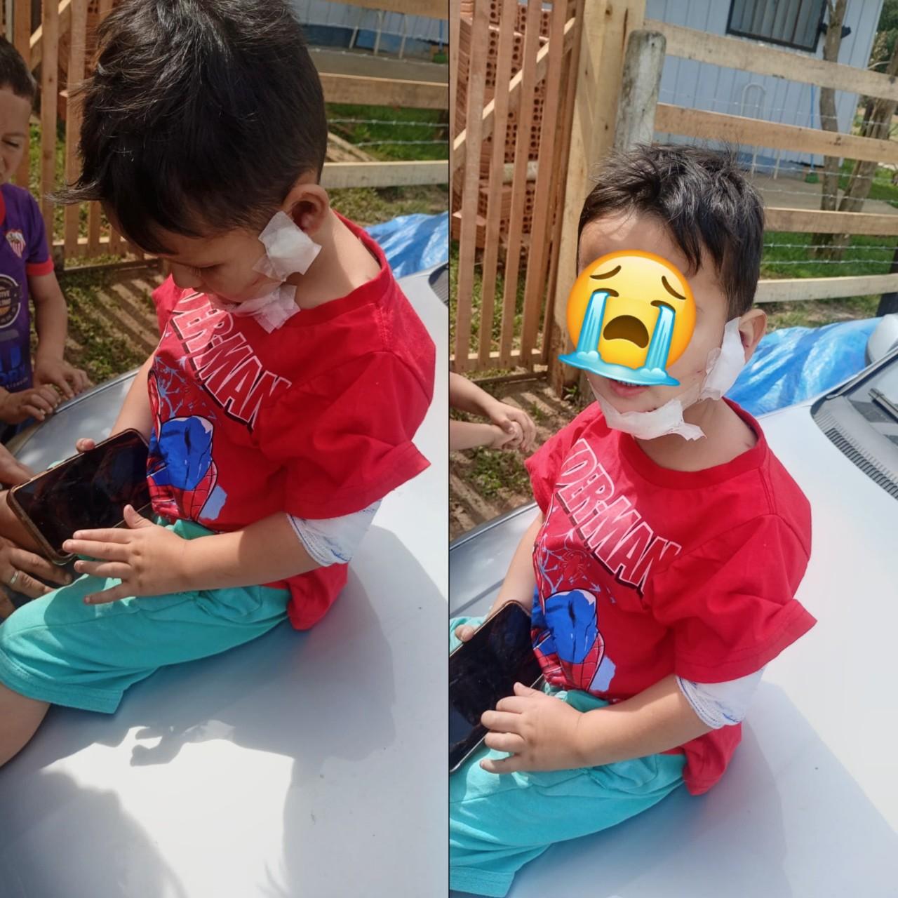 Menino de 3 anos é brutalmente atacado por cachorro em Campo Alegre